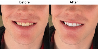 Teeth Whitening Pen