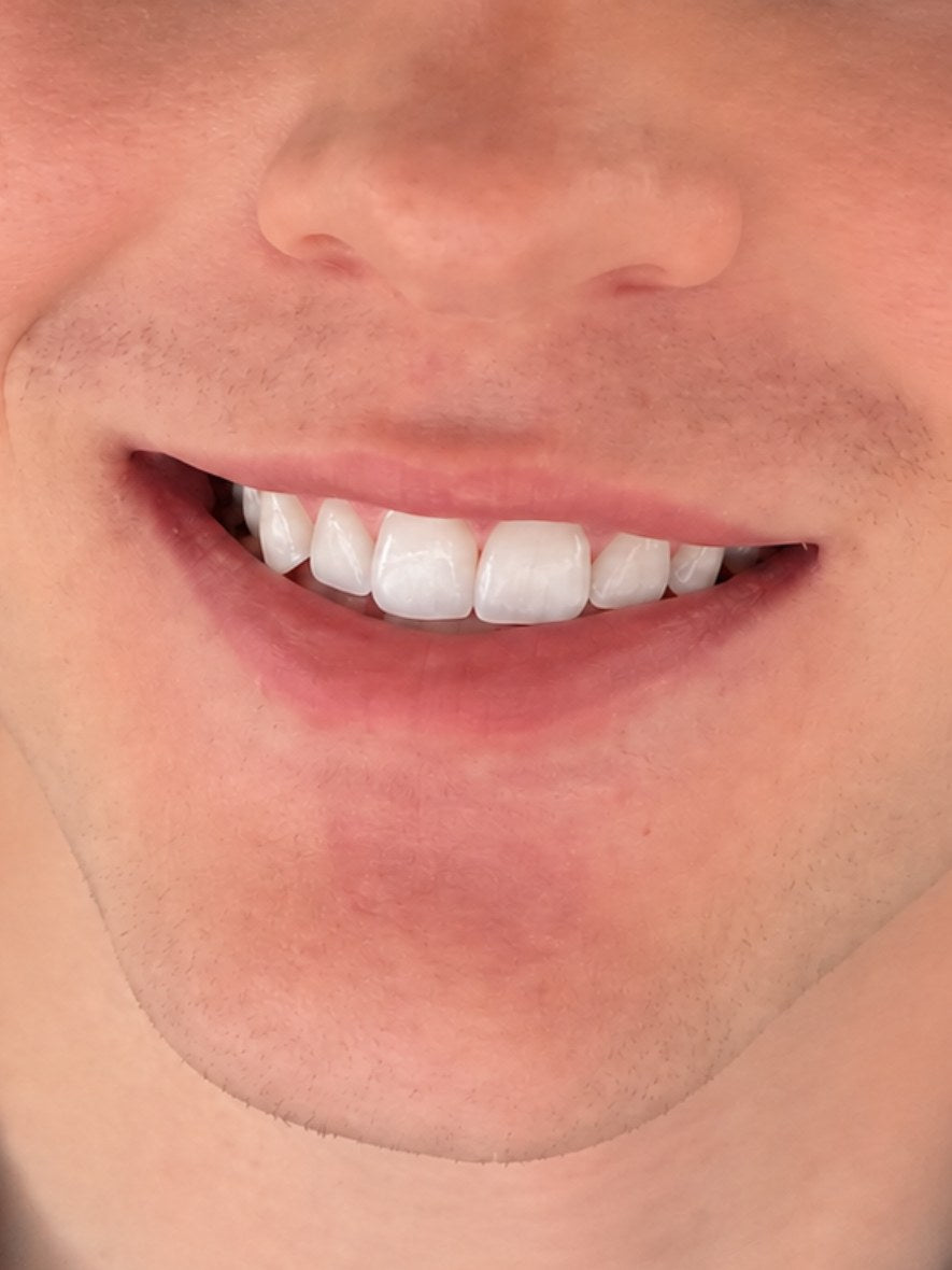 Smile after using the StealthMaxx Teeth Whitening Pen