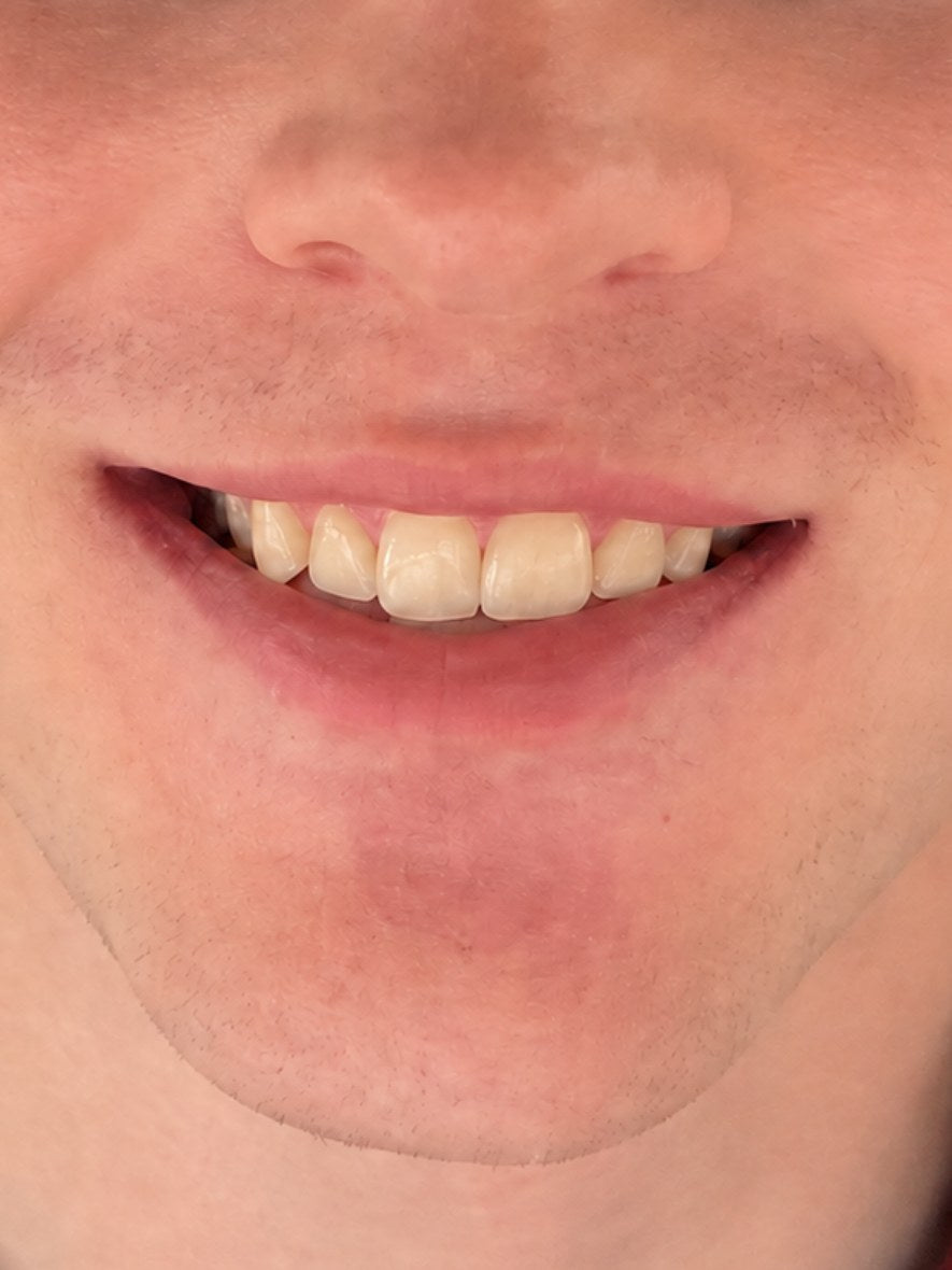 Teeth Whitening Pen, before